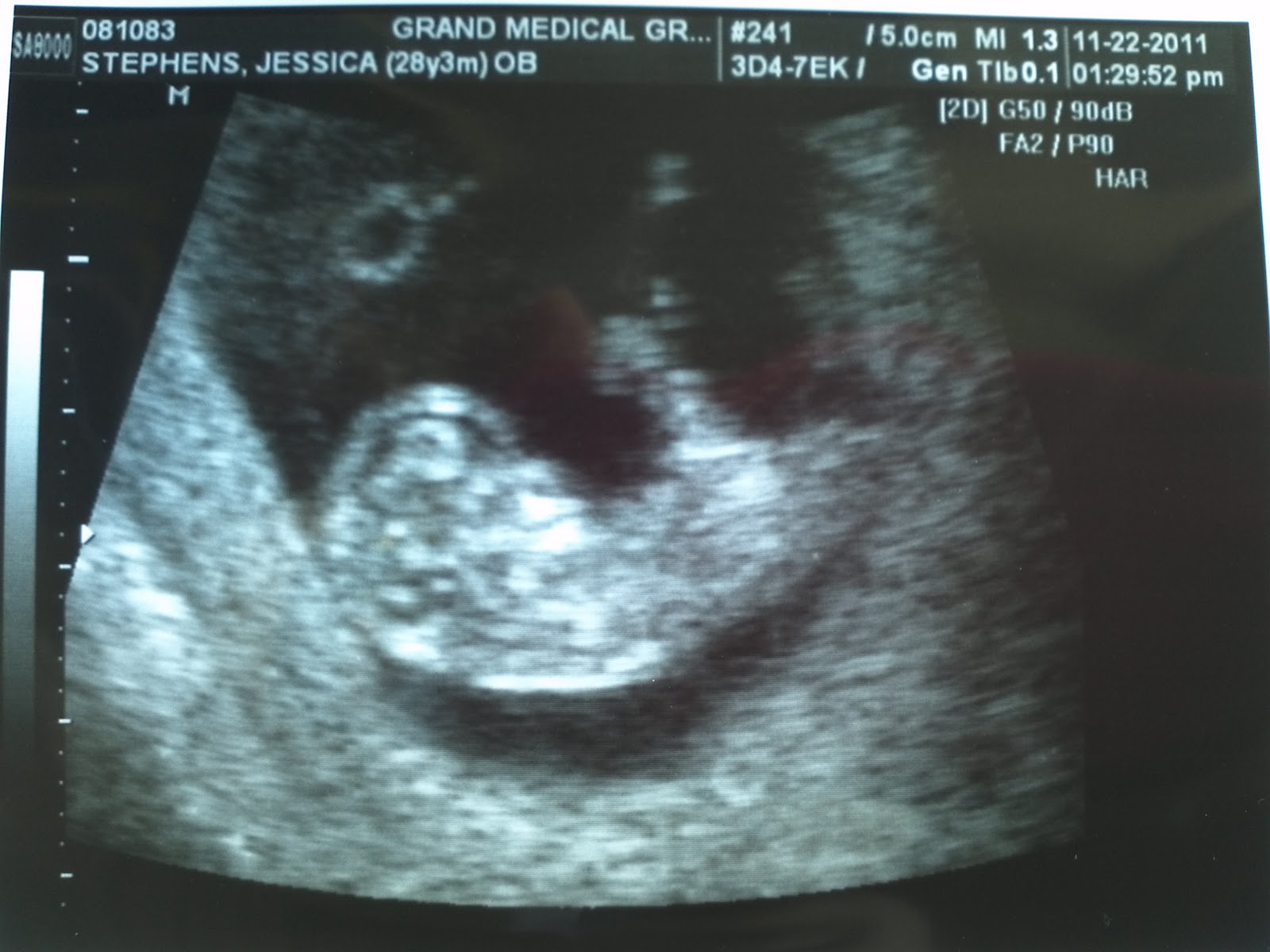 dating scan 11 weeks 3 days